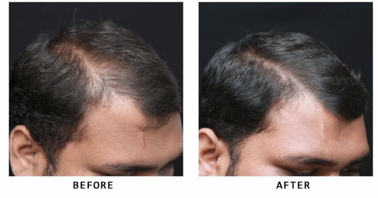 Hair Specialist Near Me – Your Complete Guide to Finding the Right Expert for Hair Loss Treatment